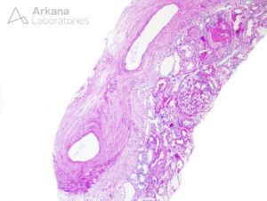 Light Chain Deposition Disease