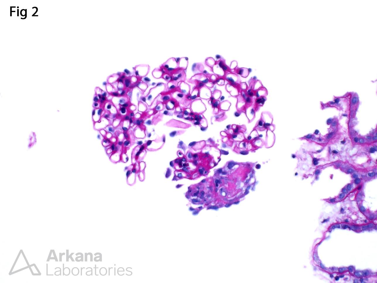 Infective Endocarditis-Associated Glomerulonephritis