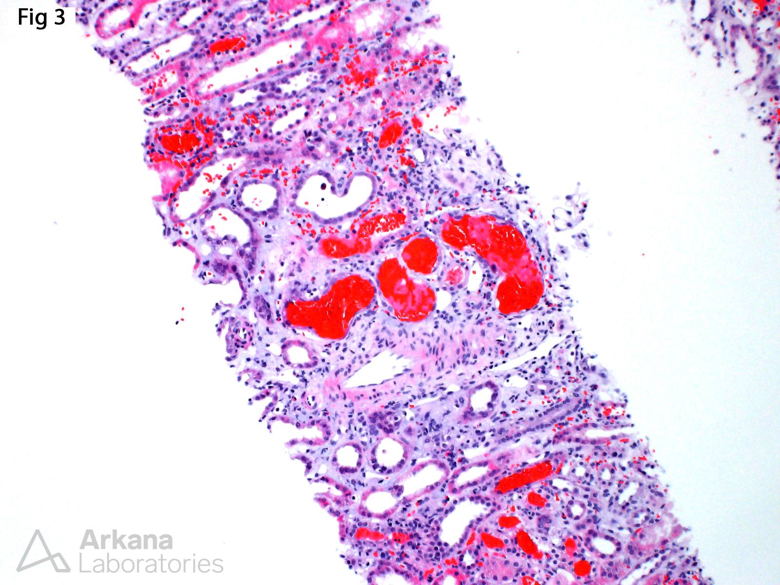 Infective Endocarditis-Associated Glomerulonephritis