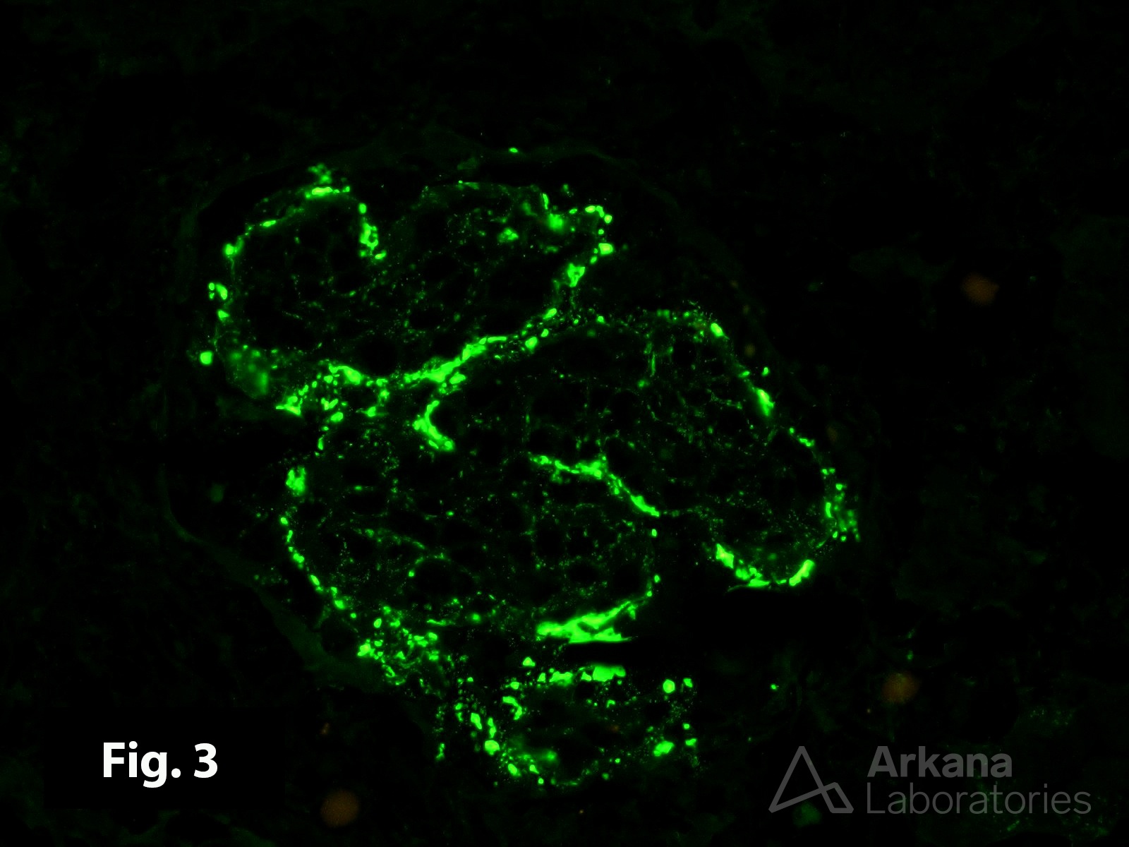 icd 10 code for glomerulonephritis due to infectious hepatitis
