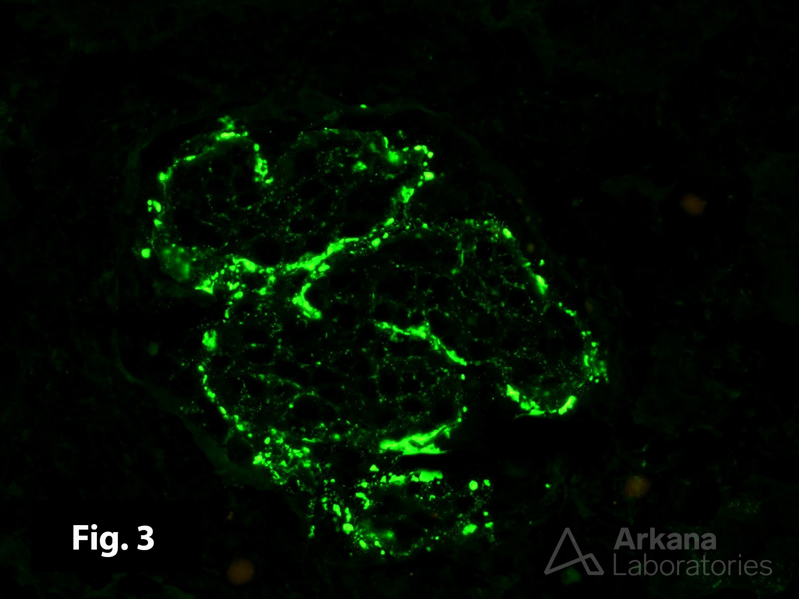 Acute Post-Infectious Glomerulonephritis