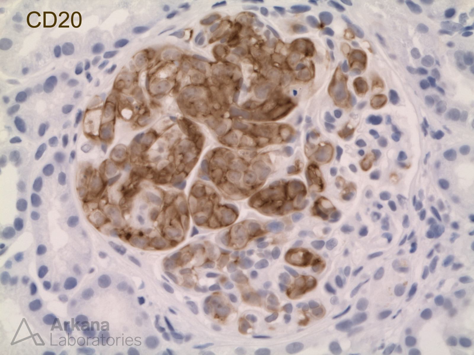 Intravascular Large B Cell Lymphoma
