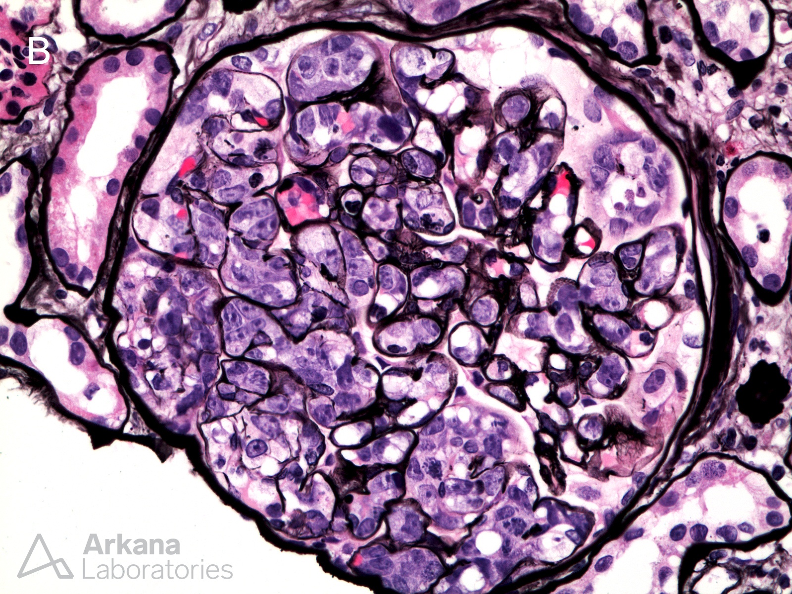 Intravascular Large B Cell Lymphoma