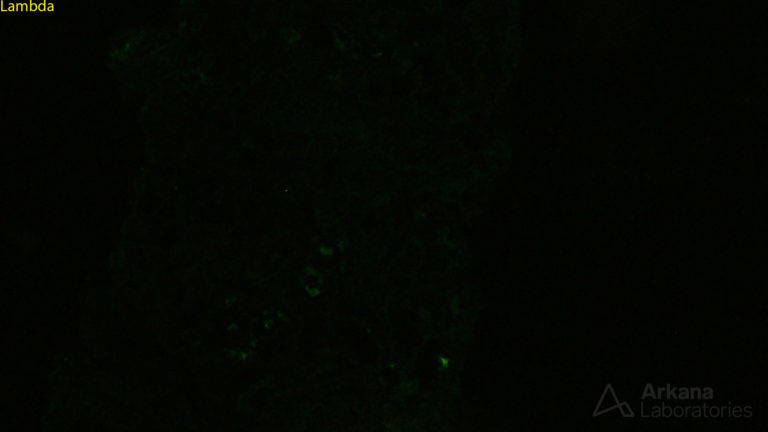 Light Chain Deposition Disease