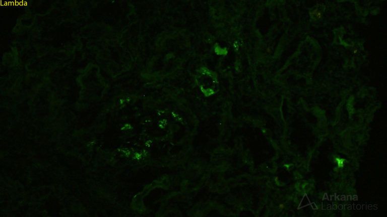 Light Chain Deposition Disease