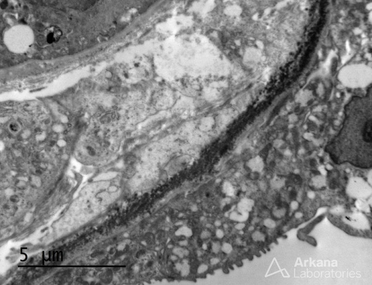 Light Chain Deposition Disease