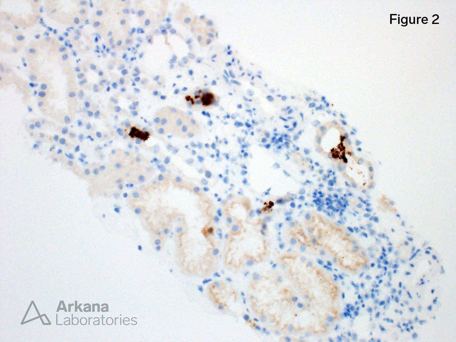 myoglobin casts by immunohistochemistry