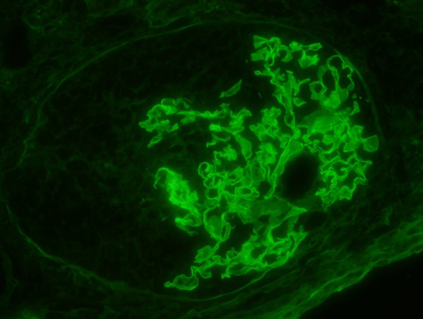 positive IgG stain, Anti-Glomerular Basement Membrane Disease