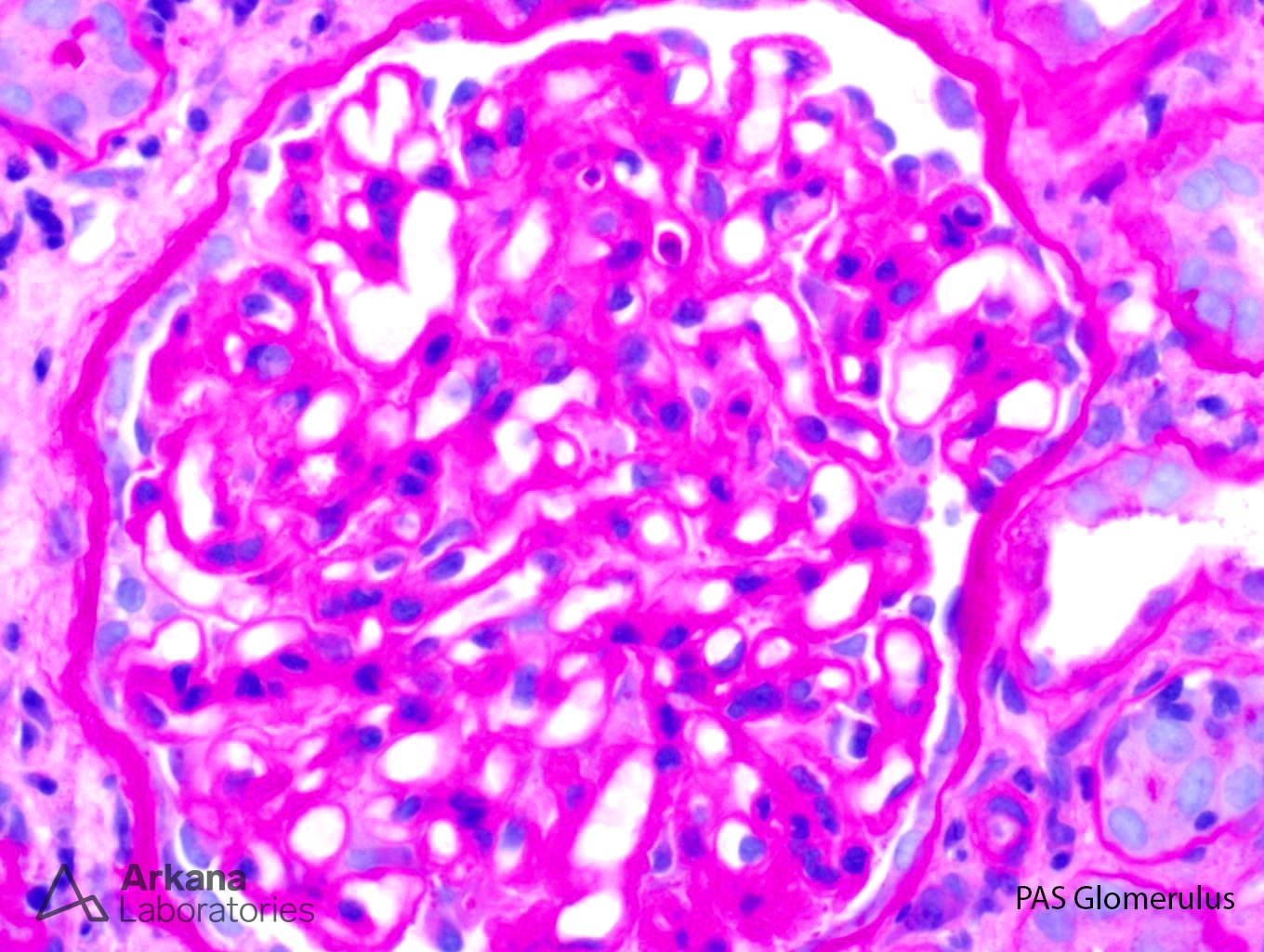 large B-cell lymphoma