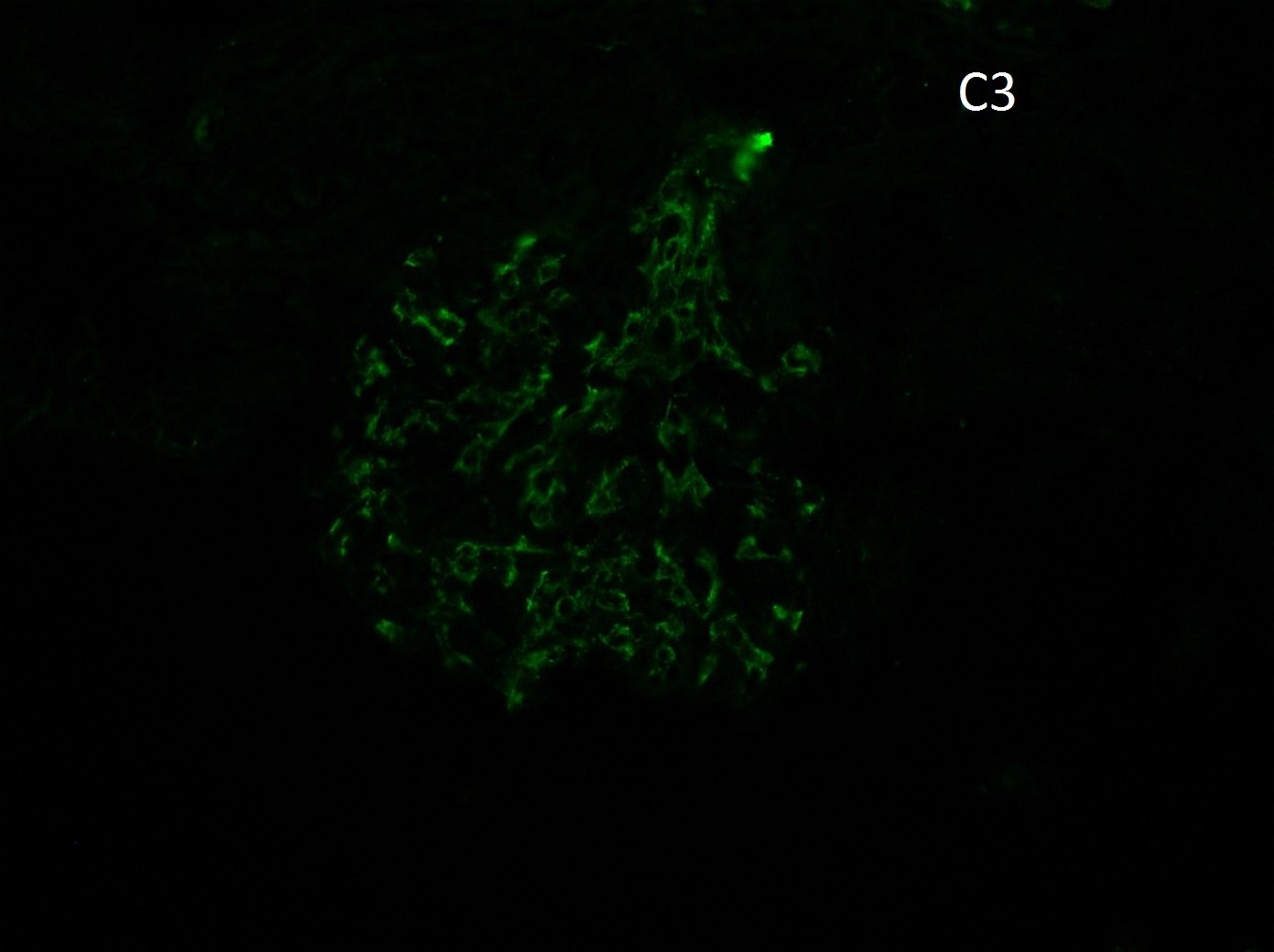 monoclonal IgG kappa deposits refers to a glomerulonephritis which stains for IgG, C3, and kappa by direct immunofluorescence
