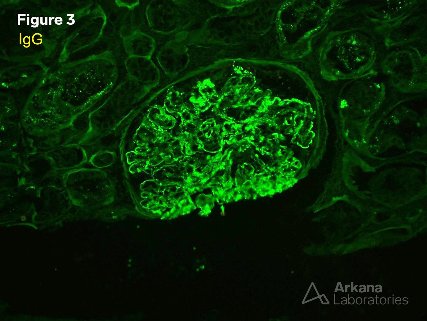 Proliferative Glomerulonephritis with Monoclonal IgG Deposits (PGMID)