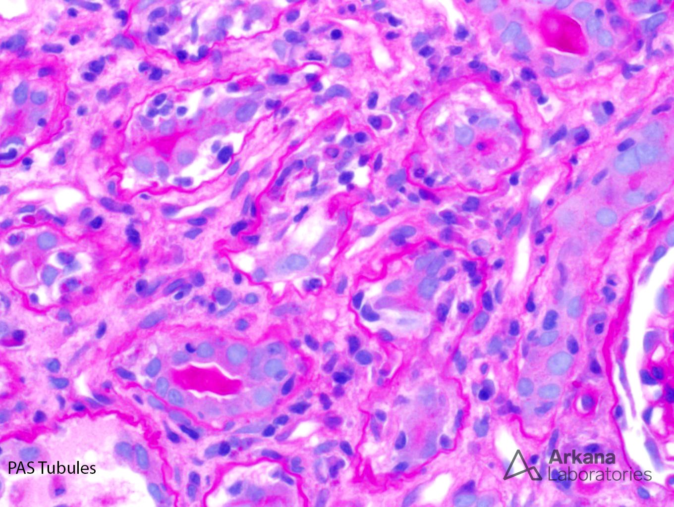 large B-cell lymphoma, marked tubulitis