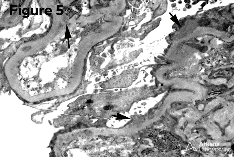 electron microscopy image of Proliferative Glomerulonephritis
