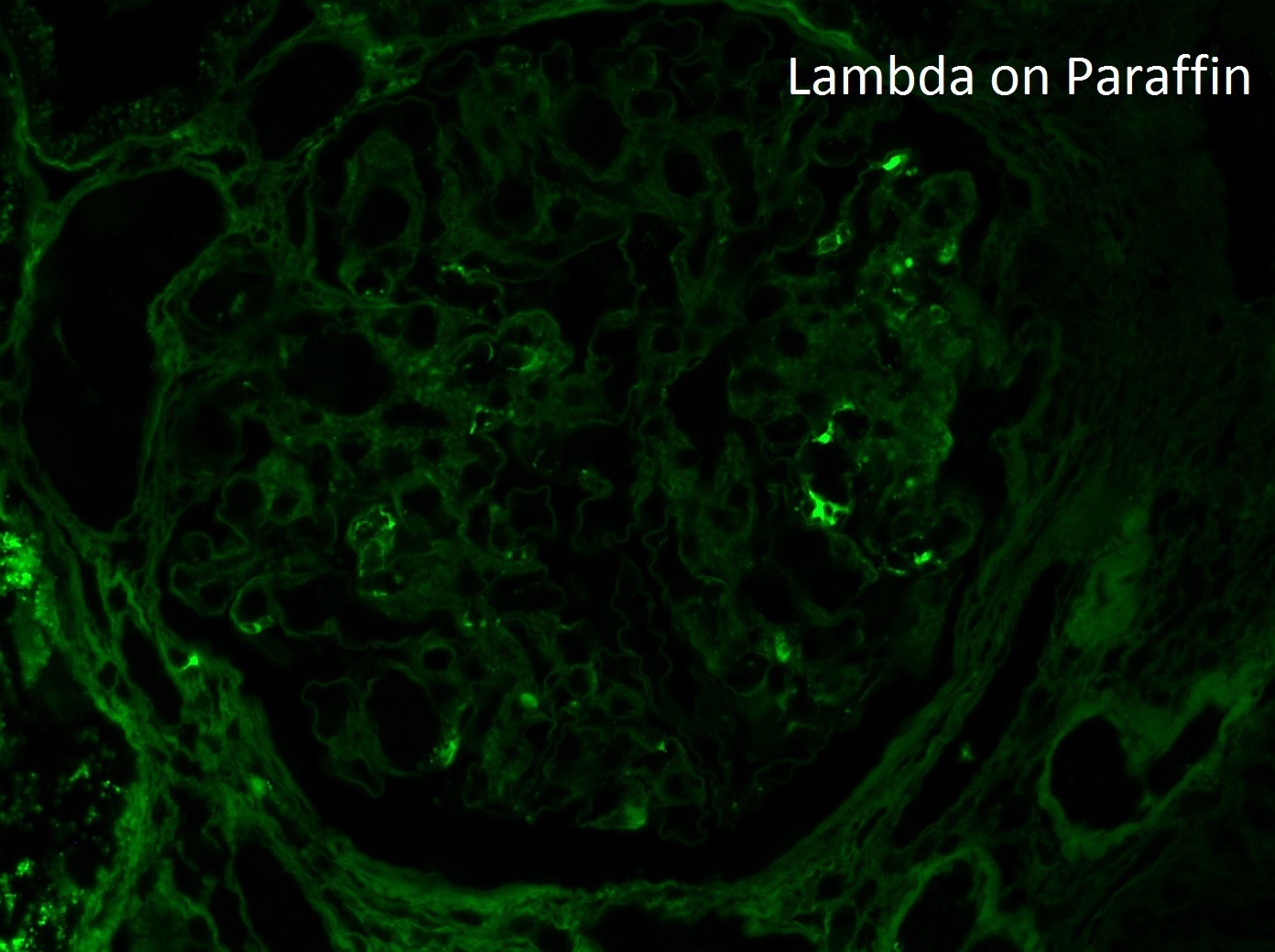 Membranous-like Glomerulopathy with Masked IgG Kappa Deposits