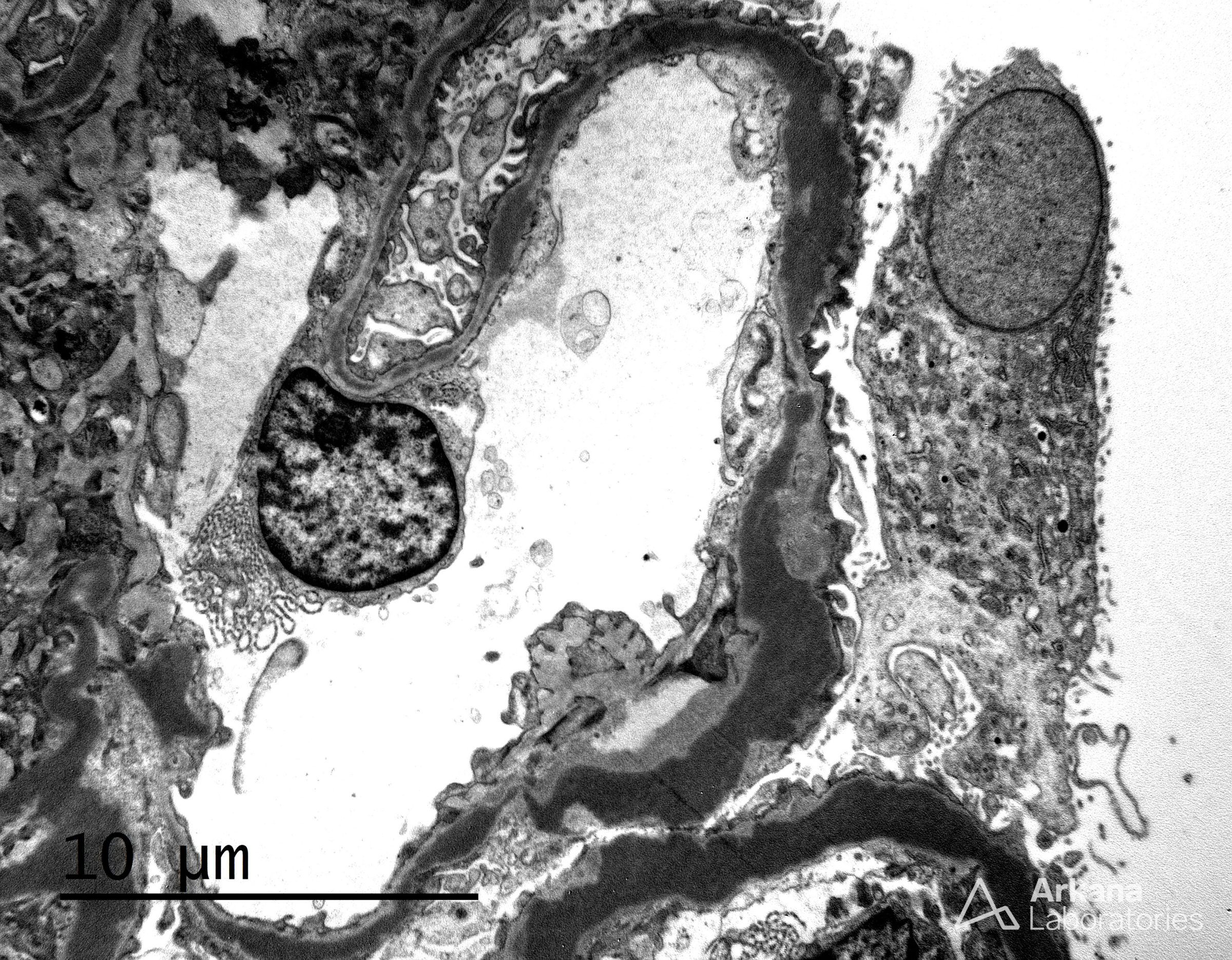 Dense deposit disease