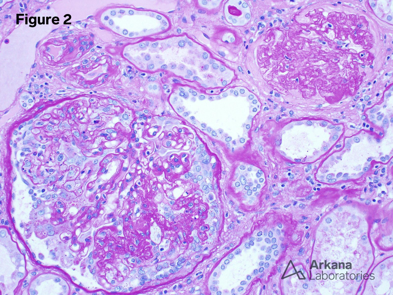 Renal Cell Carcinoma 