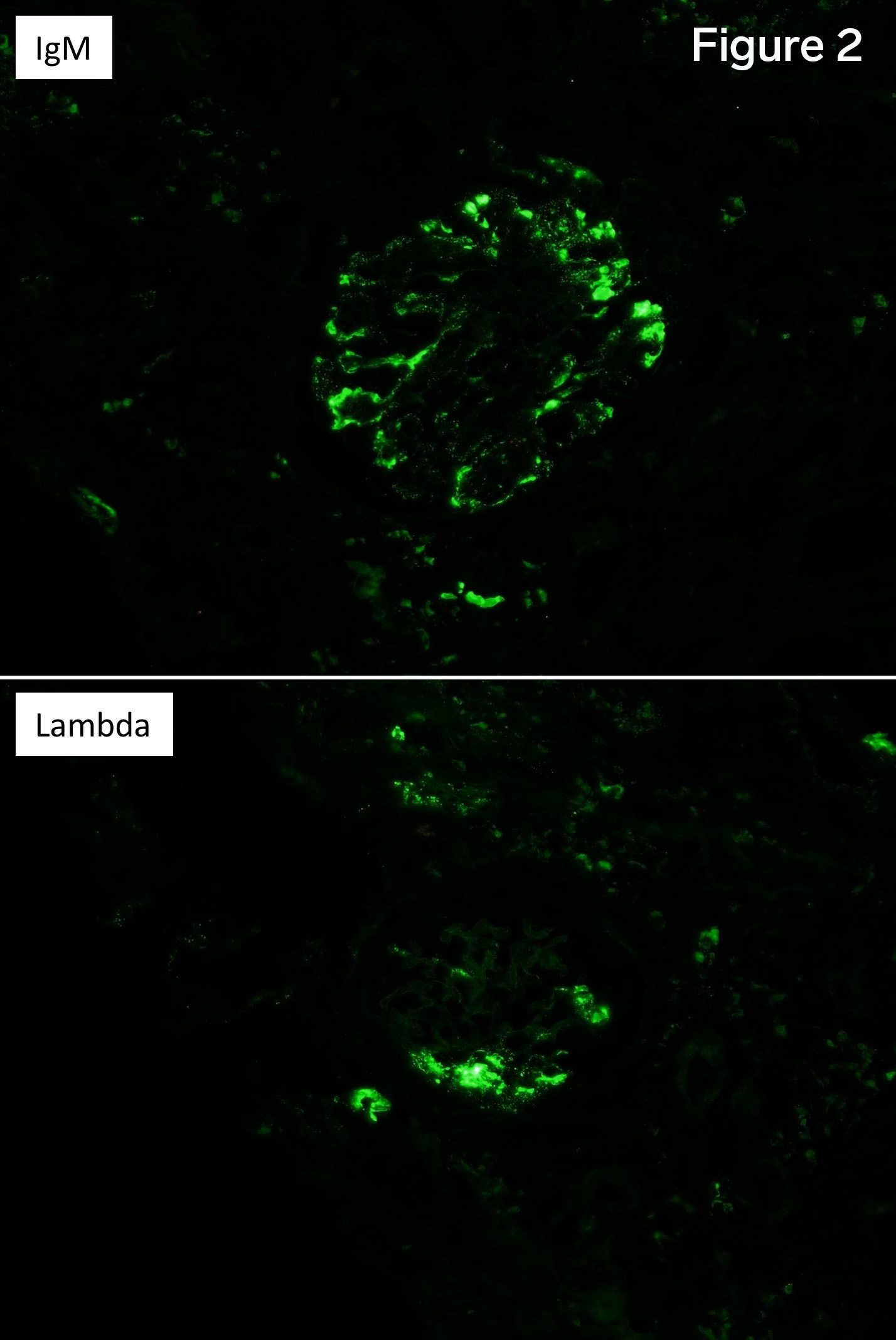 strong positivity of the pseudothrombi for IgM and lambda light chain only, Cryoglobulinemic Glomerulonephritis