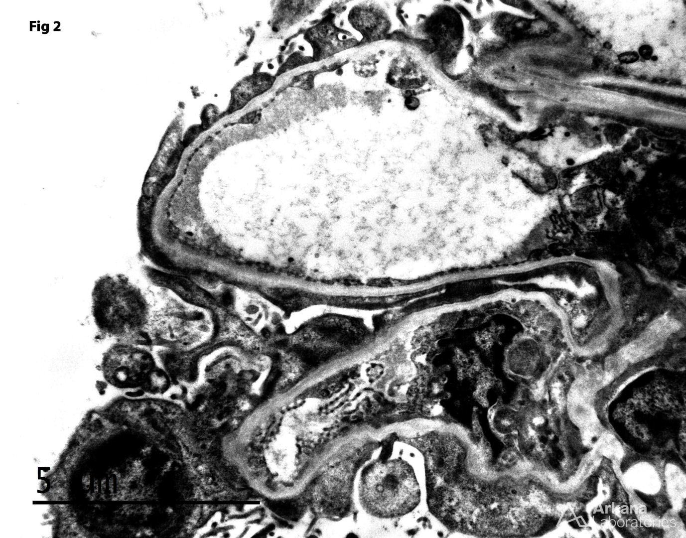 Diffuse Mesangial Hypercellularity