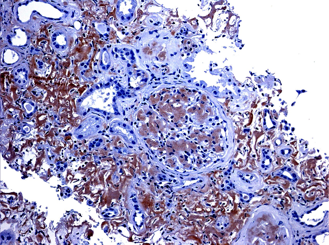 Amyloid Composed of Leukocyte Chemotactic Factor 2 (LECT2)