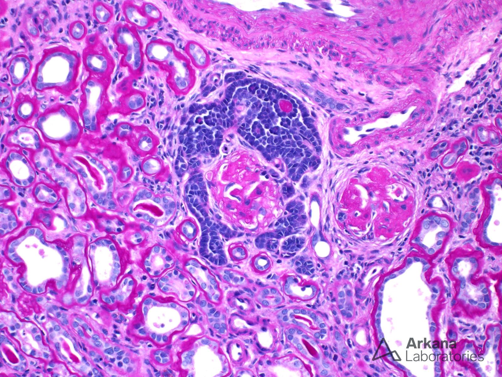 embryonal hyperplasia/metaplasia of Bowman’s