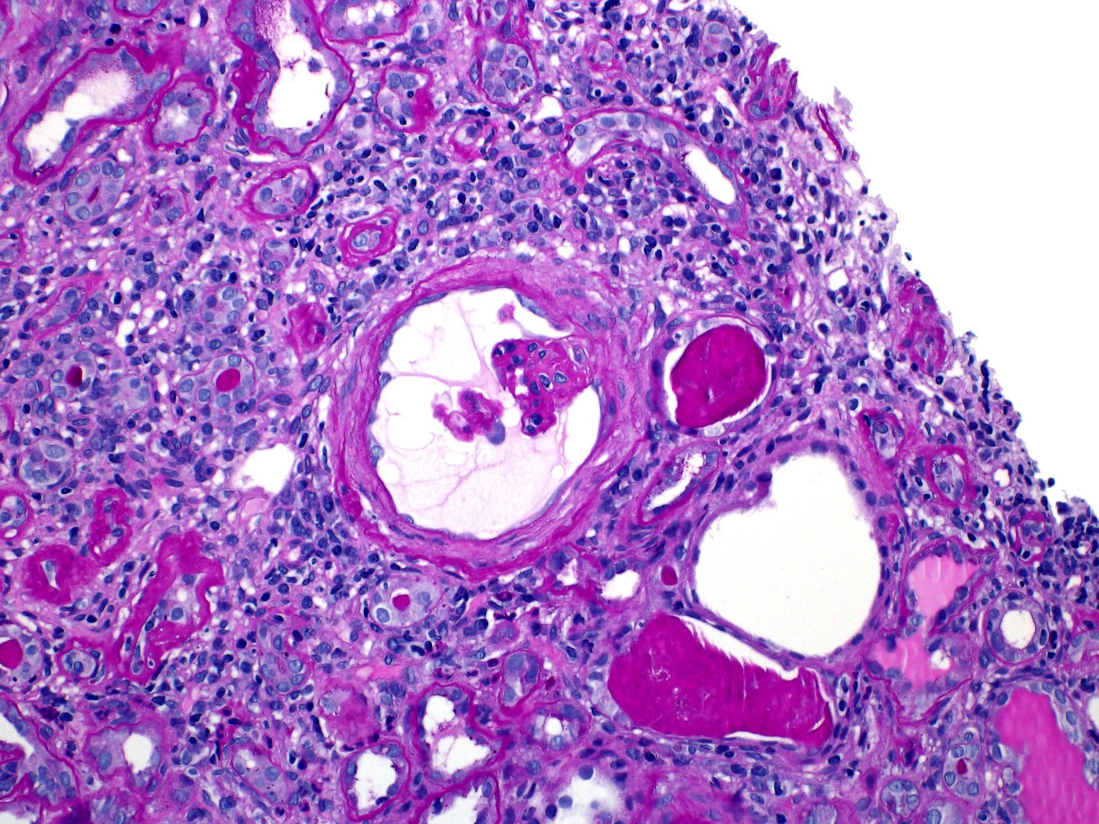 HIV-associated nephropathy (HIVAN)