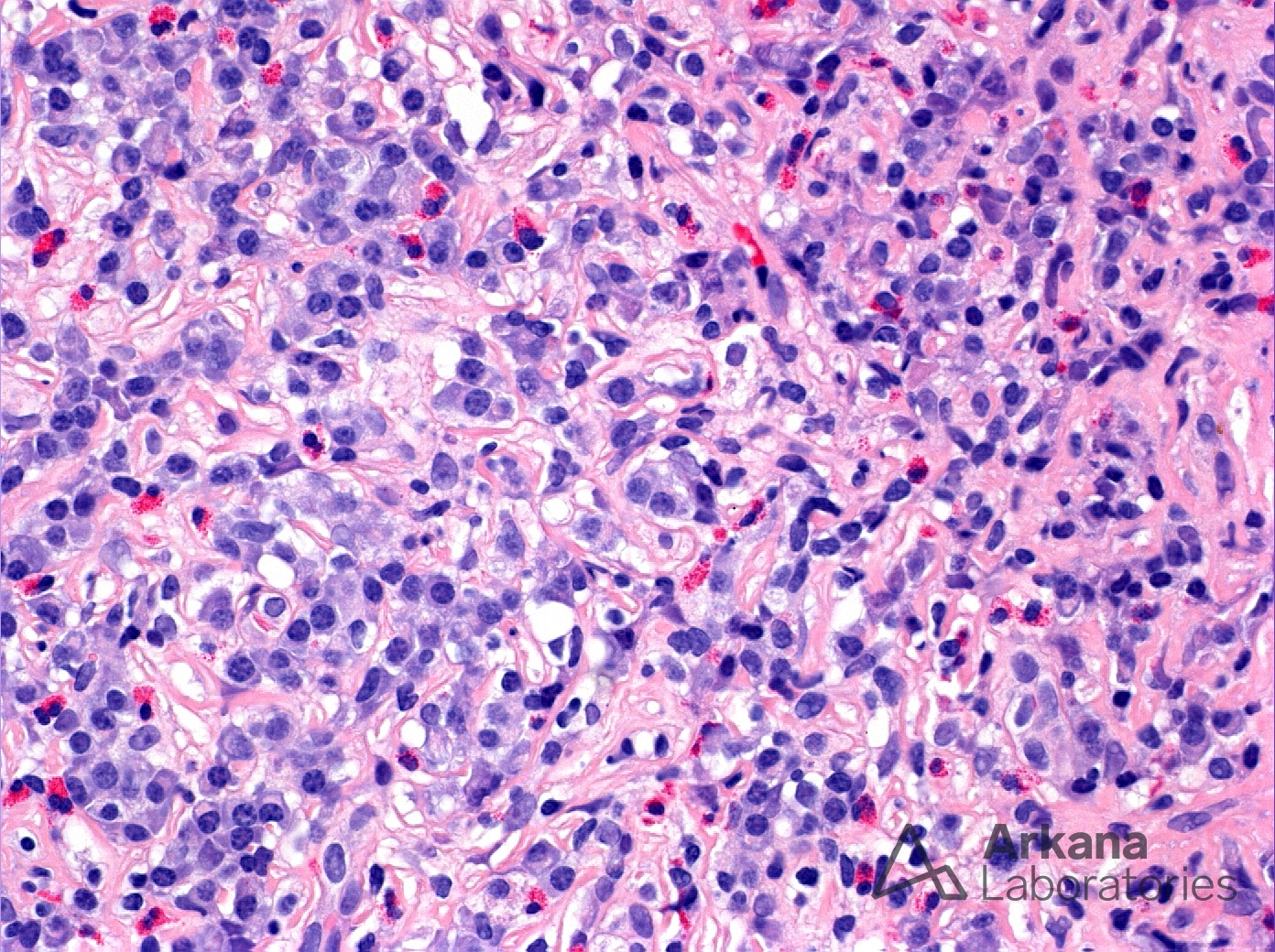 IgG4-Positive Plasma Cells