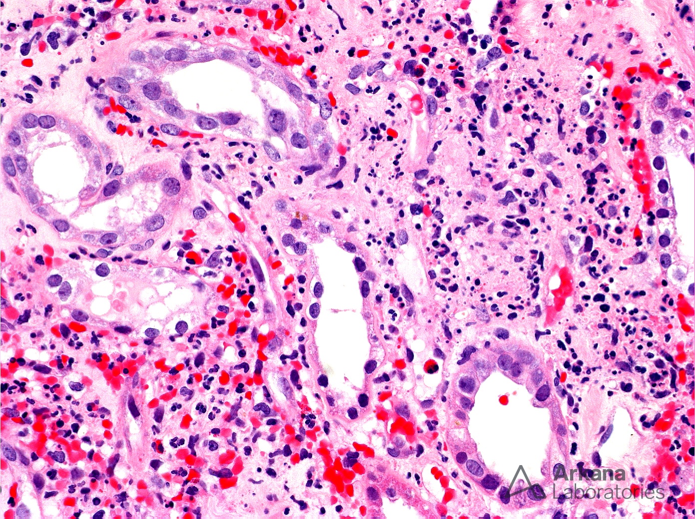 Medullary Angiitis