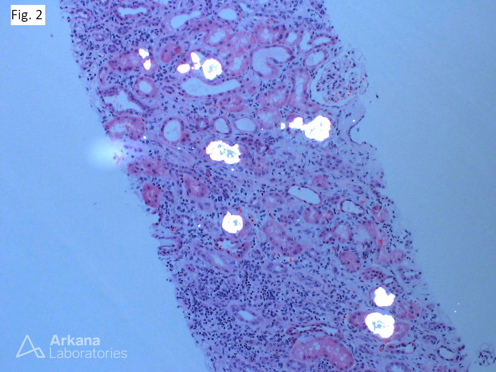 Oxalate Nephropathy