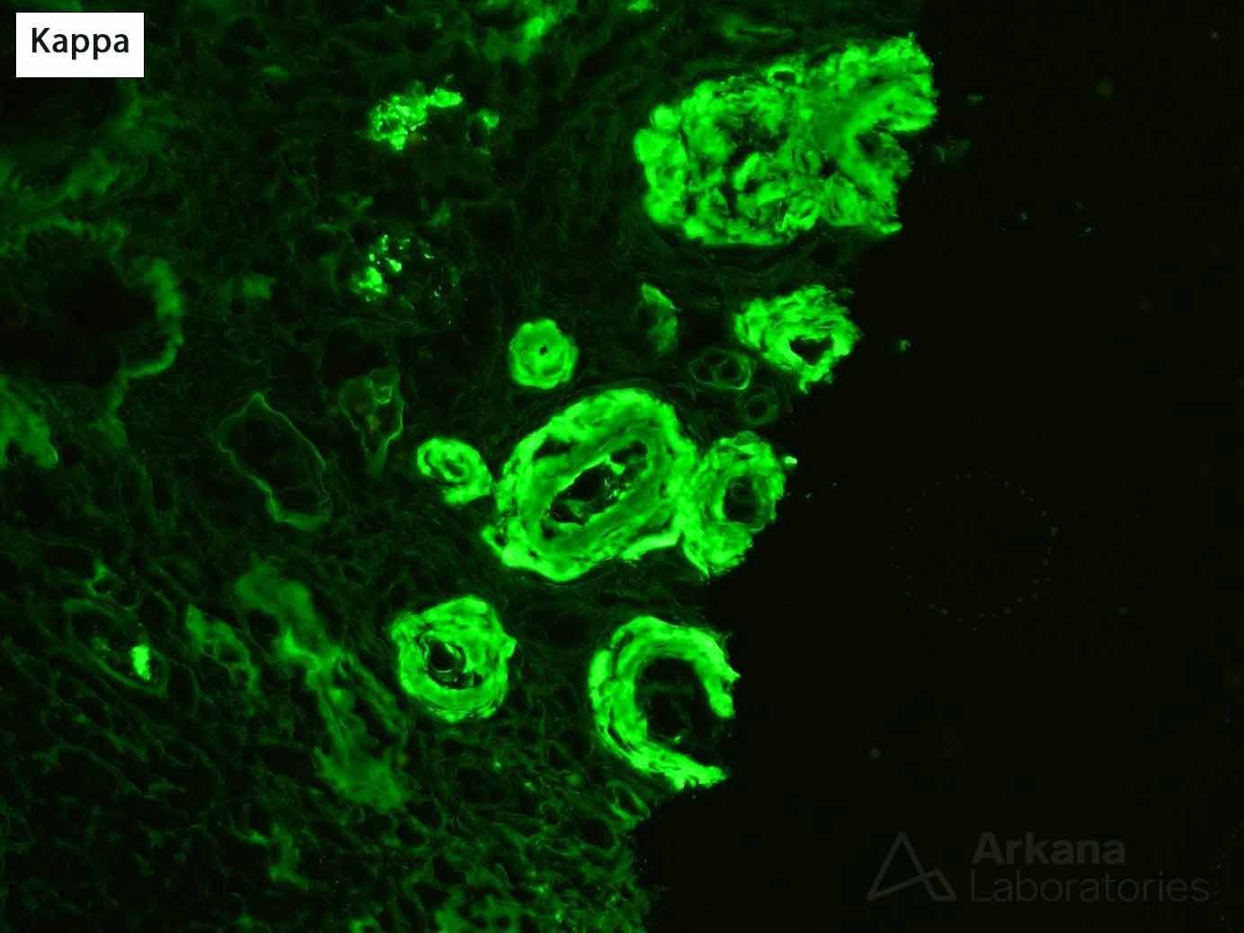 AL Amyloidosis