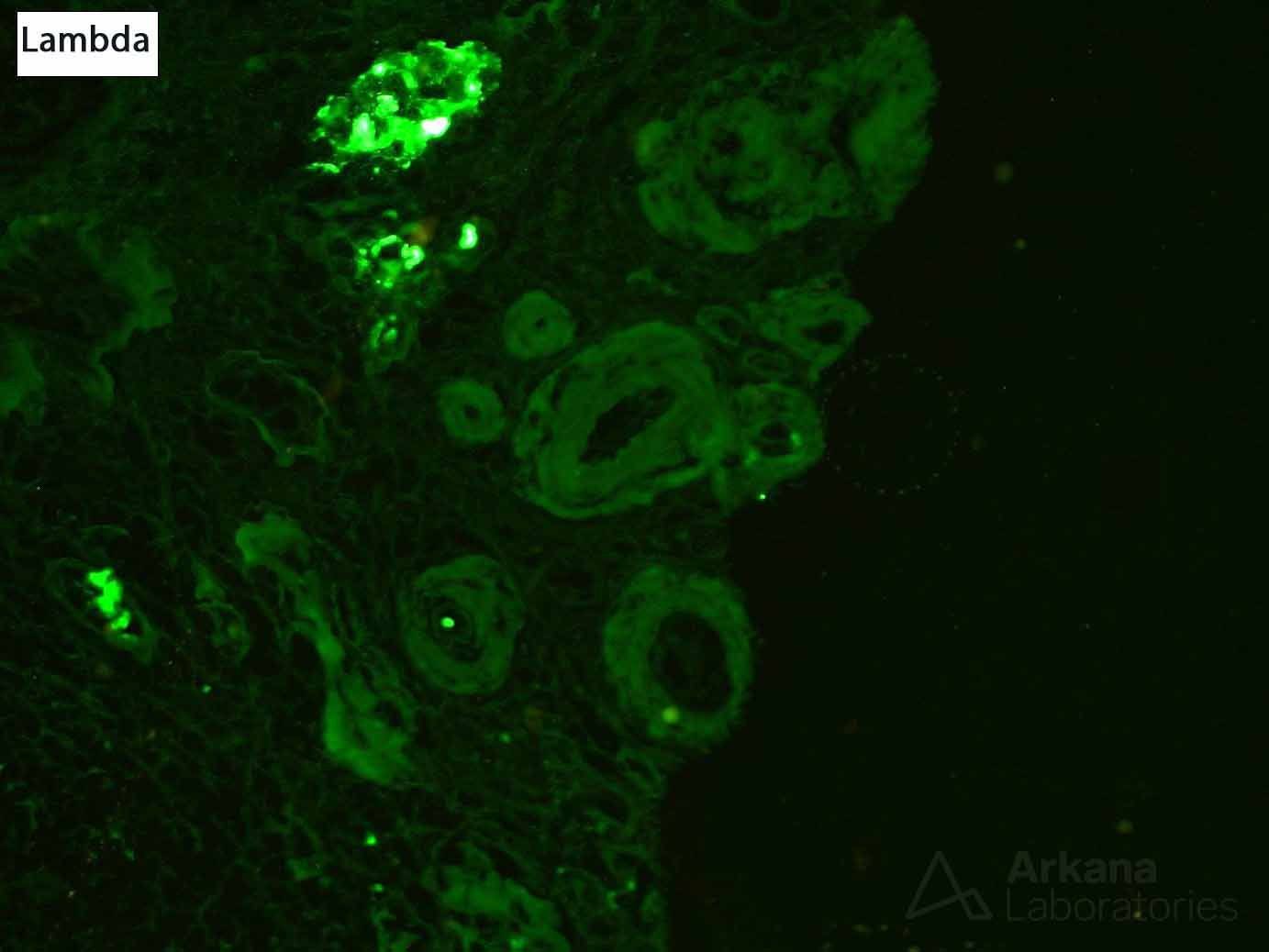 AL Amyloidosis