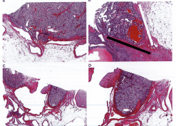 Renal Cell Carcinoma