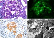 Renal Manifestations of Inflammatory Bowel Disease