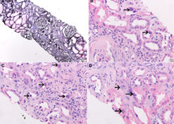 Native kidney biopsy, arrows point to karyomegaly
