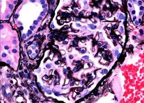 Serum amyloid P component deposition