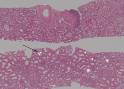 Different number of calcium oxalate deposits in kidney biopsy cores fixed in formalin and Michel transport medium