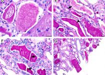 Morphologic spectrum of hyaline and uromodulin casts