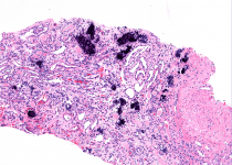 crystalline nephropathies