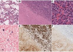 Pneumonia with diffuse necrosis and EBV-infected cells