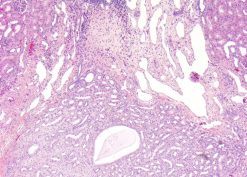 Renal Hypoplasia