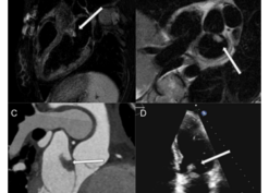 MRI shows a T2-hyperintense mass with irregular borders