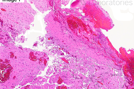 Cerebral Amyloid Angiopathy, Neuro Notes, Neuropathology