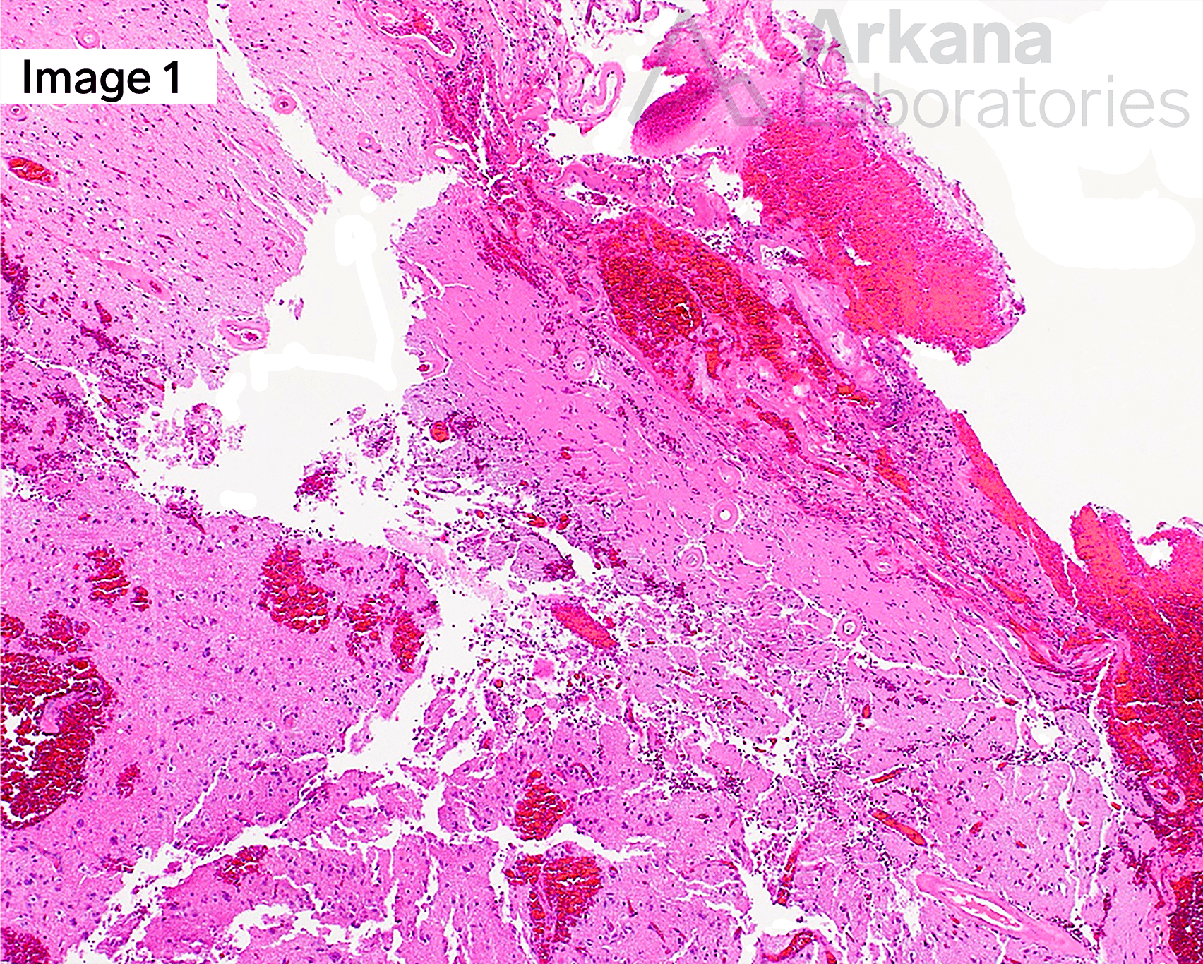 Cerebral Amyloid Angiopathy, Neuro Notes, Neuropathology