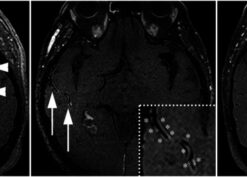 Variation of VWE findings in patients with CAA