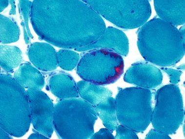 diagnostic image of nerve and muscle biopsy sent to arkana laboratories stained blue