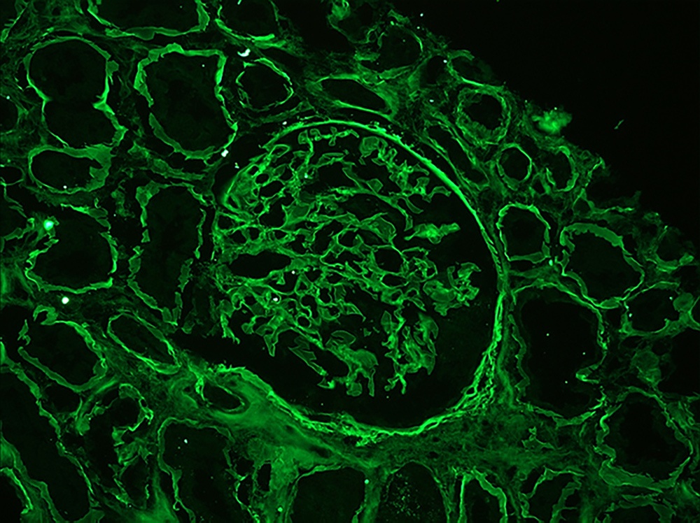 Immunofluorescence image for quiz over Immunofluorescence diagnosis