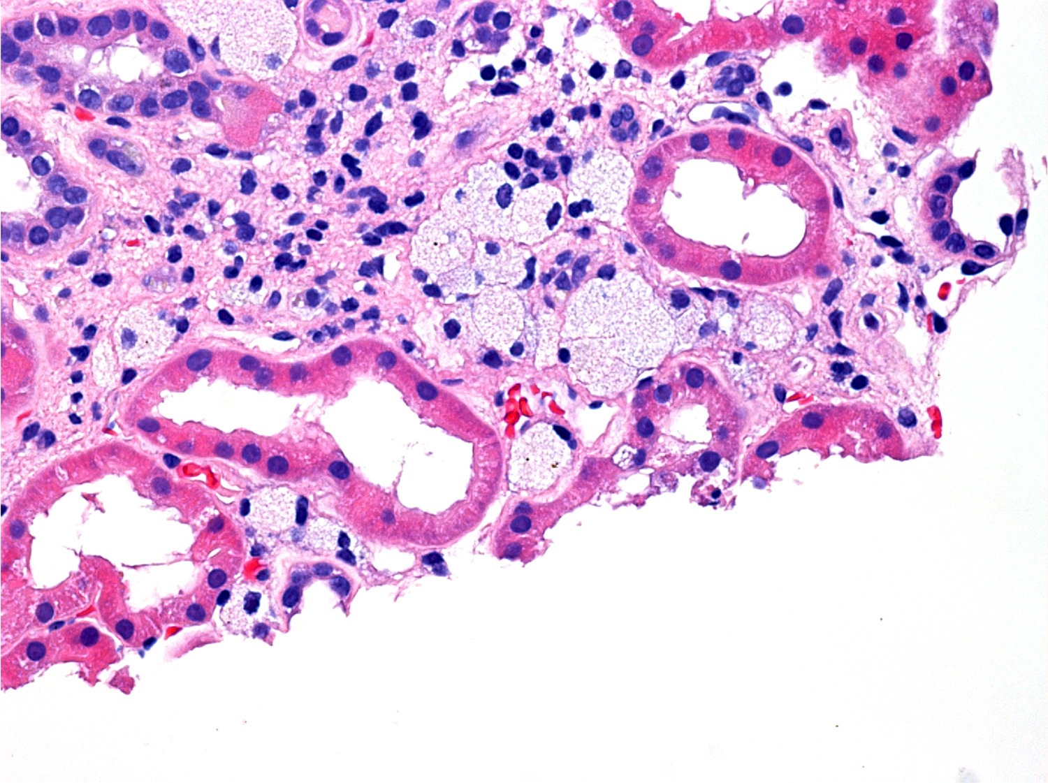 renal diagnostic image showing tubulous