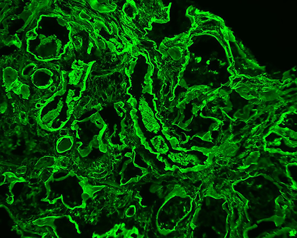 positive Immunofluorescence stain of renal biopsy
