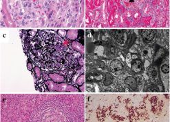Histopathological findings in renal and the inguinal lymph node biopsies from the patient with MCD