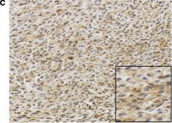 Representative staining intensity scores for CD133 at ×200