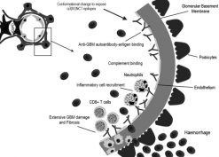 Molecular pathogenesis of anti‐glomerular basement membrane disease.